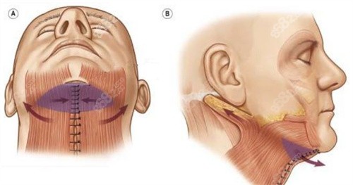 颈阔肌成形术改善双下巴
