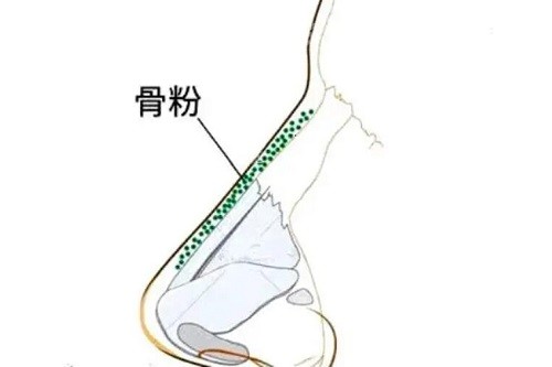 骨粉注射隆鼻展示