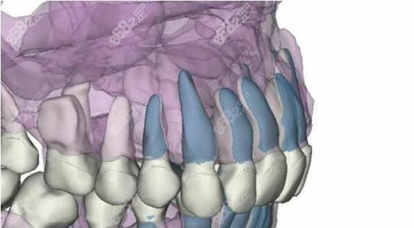 牙齿牙根形态模拟图