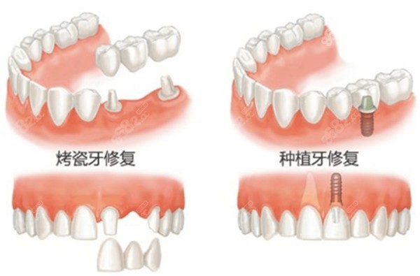 种植牙和镶牙哪个对身体更好