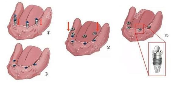 20221010225030.jpg 半固定種植.jpg