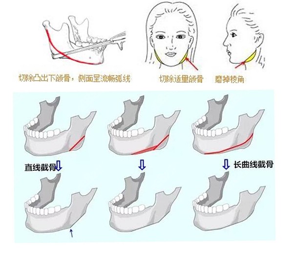 高俊明做下颌角怎么样？