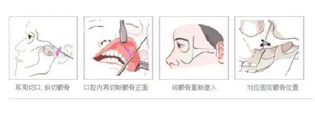 磨颧骨的手术方式