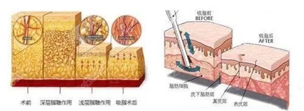 手术吸脂的原理图