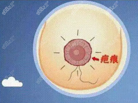 双环悬吊术后多久褶皱消除