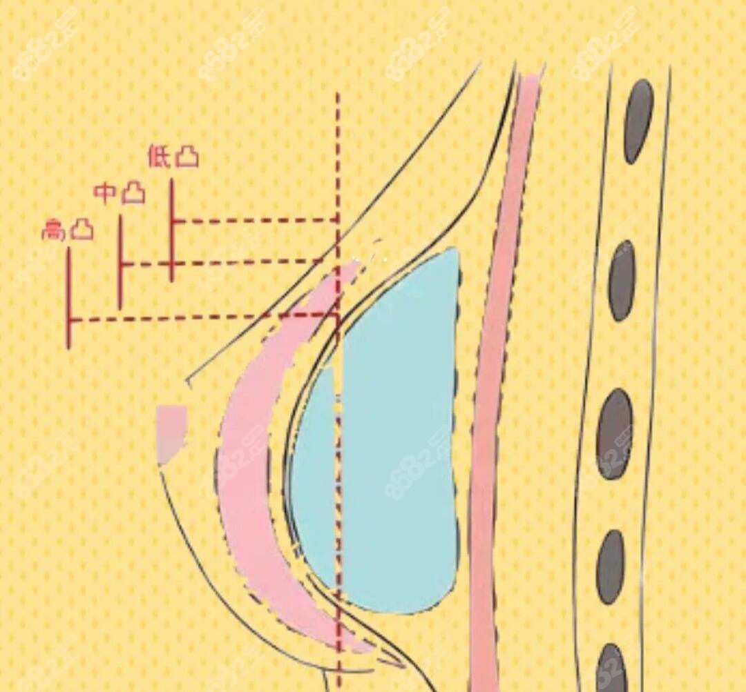 隆胸中凸高凸的对照图图片