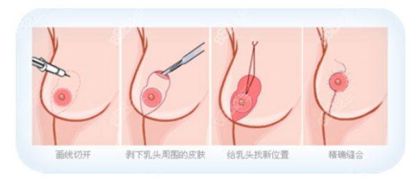 双环悬吊术疤痕明显吗