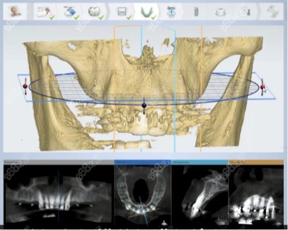 全口牙種植修復(fù)半固定需多少錢 全口牙種植修復(fù)半固定需多少錢