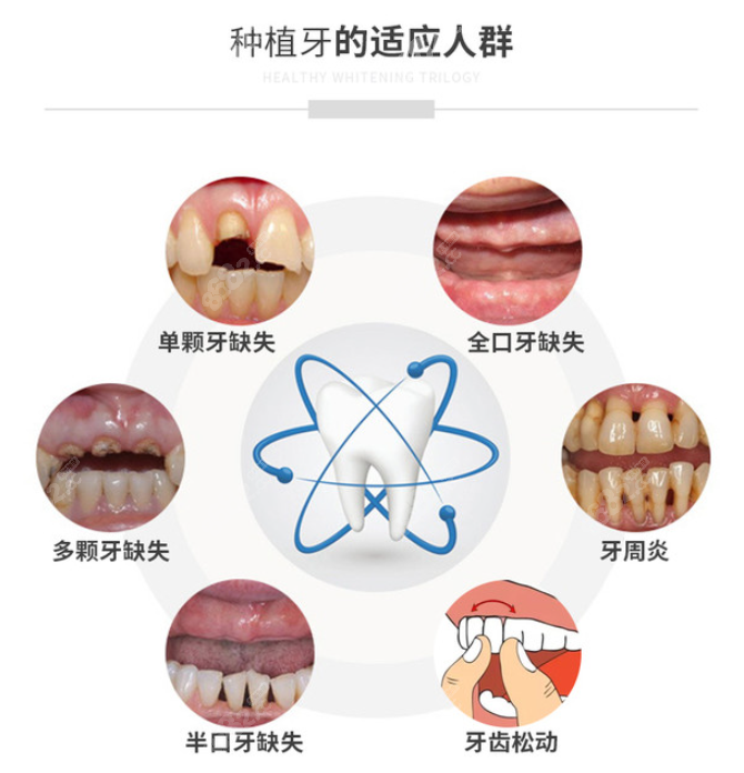 种植牙要具备什么条件才能做