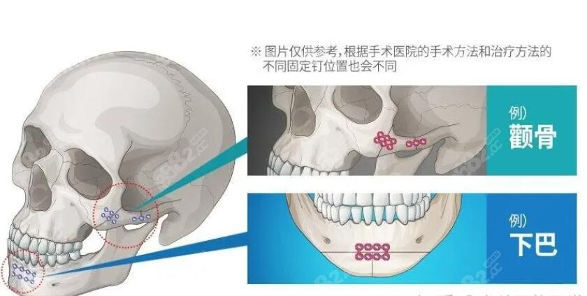 颧骨内推打钛钉的位置