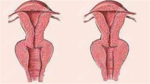 3d生物束带手术方式