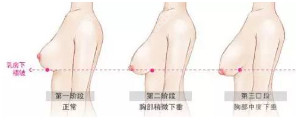 双环法乳房悬吊术前后对比图片