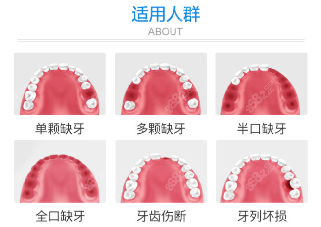 贵港种植牙有5000元一颗便宜点的吗