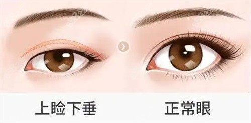 下垂眼睑和正常眼睑形态