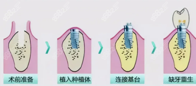 种植牙失败费用谁承担