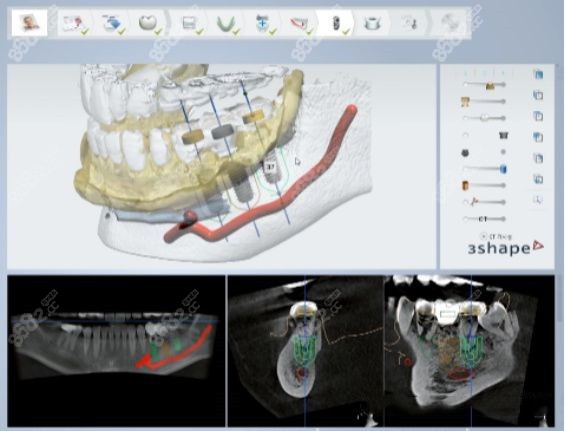 全口半固定種植牙怎么樣 全口半固定種植牙怎么樣