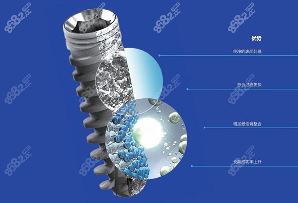 奥齿泰TSIII CA亲水种植体的优点
