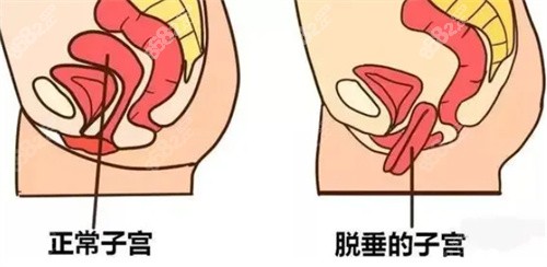 什么是3d生物束带紧缩术？