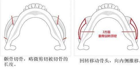 颧骨内推和磨颧骨有什么不同？