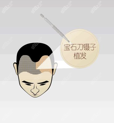 秦皇島剃發(fā)植發(fā)多少錢