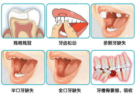 泸州牙博士口腔做种植牙怎么样