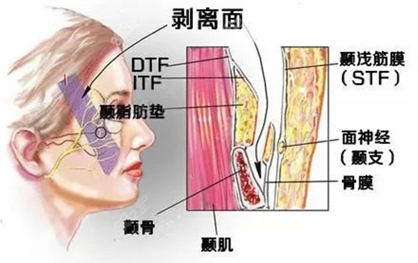 小切口筋膜提升的剥离层次