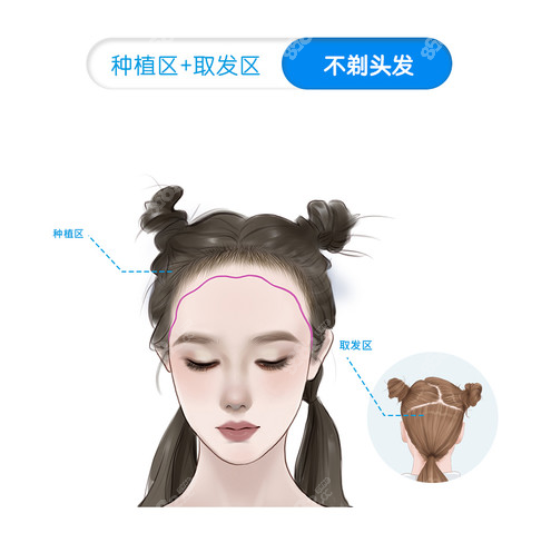 秦皇島不剃發(fā)植發(fā)多少錢