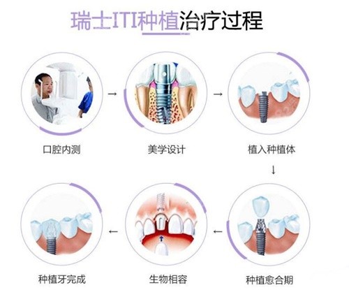 全口种植牙亲身经历--瑞士iti种植牙质量更好