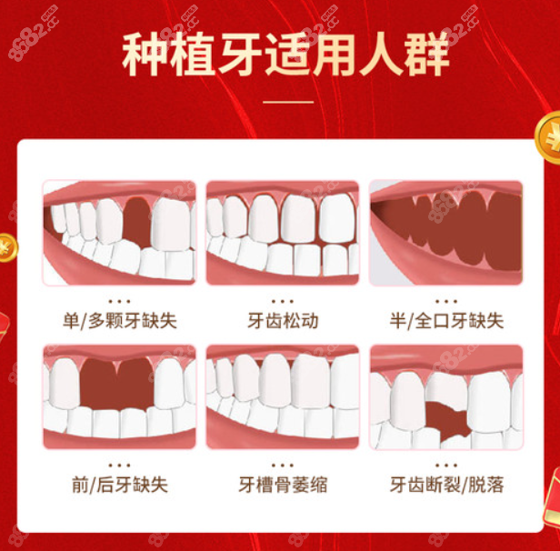 韩国种植牙适合哪些人群使用