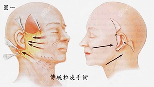 普通拉皮手术的切口大小