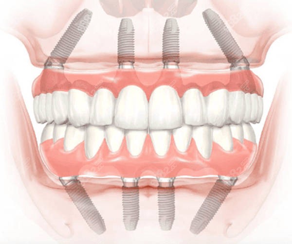 全口种植牙