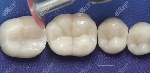 福田区补牙多少一颗