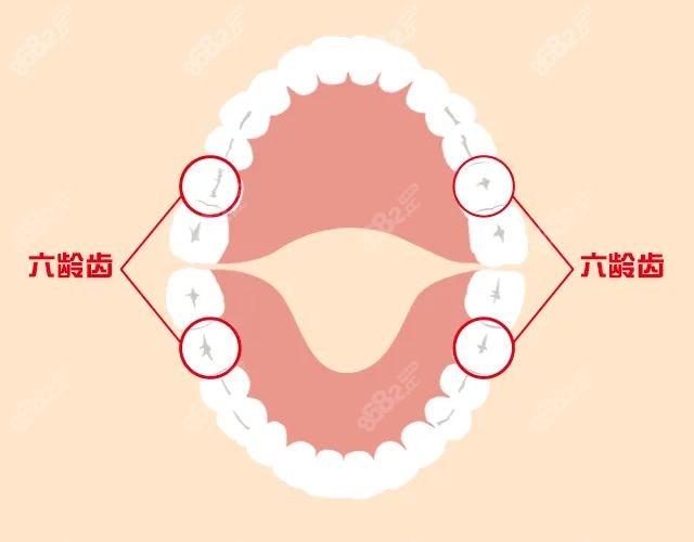 儿童六龄齿位置图示