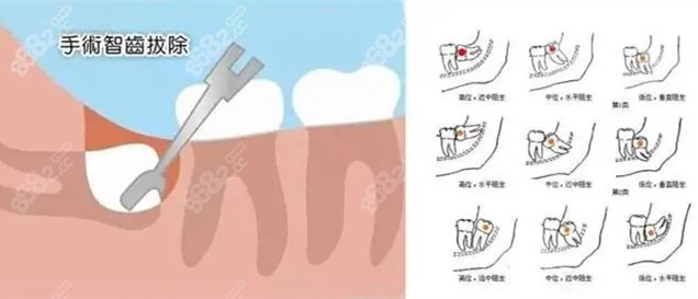 大同拔智齿的相关价格