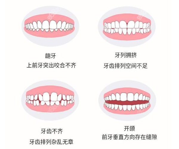 牙齿正畸戴牙套矫正地包天怎么样