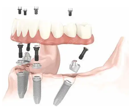 南宁青秀区全口种植牙价格多少