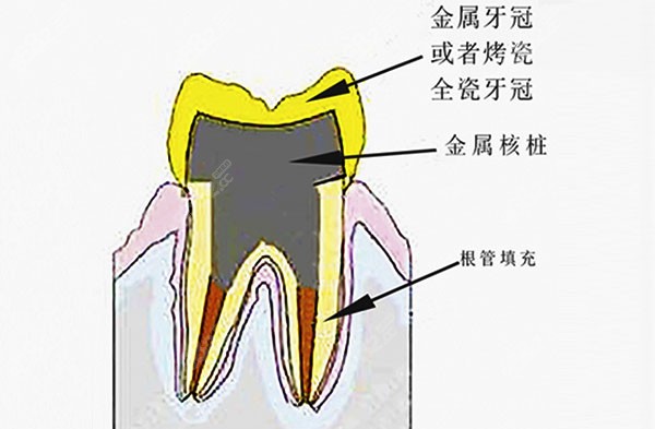 根管填充方式