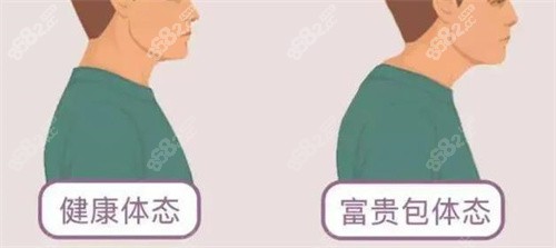 富贵包影响形象体态