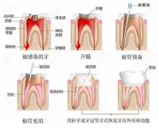 兰州牙王国数字化口腔根管治疗收费