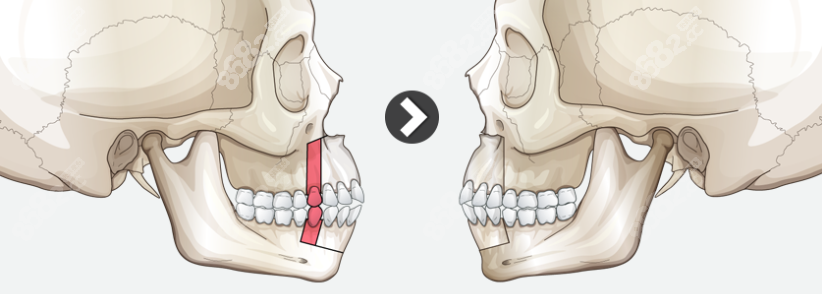 双鄂手术矫正突嘴