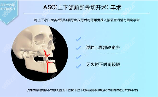 ASO上下颌前部骨切开术