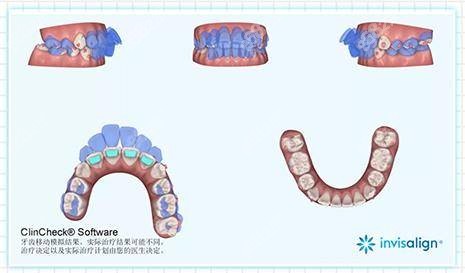 刘俊医生可做不拔牙牙齿矫治