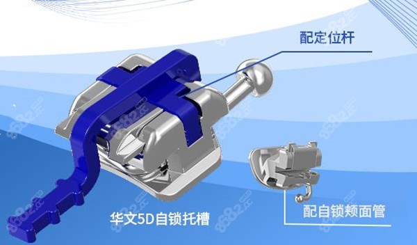 華文正畸5D自鎖托槽的特點 華文正畸5D自鎖托槽的特點