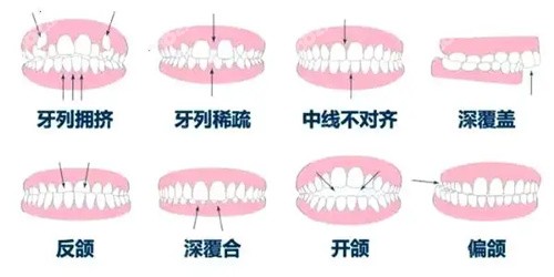 西安诺贝尔口腔的隐形矫正技术