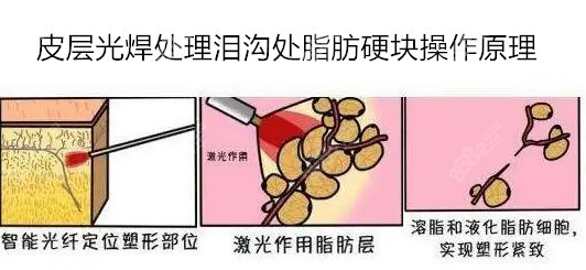 皮层光焊处理泪沟处脂肪硬块操作原理