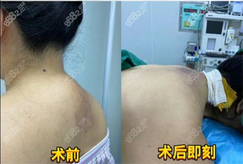黄学峰整形团队真人术后对比