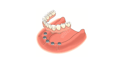 全口吸附性義齒和普通義齒的區別
