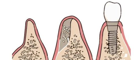 牙周情况对种植牙的影响
