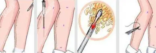 大腿吸脂手术伤口