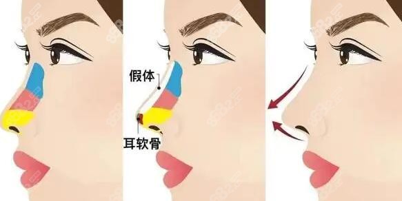 上海艺星许炎龙做鼻子怎么样